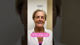 Facelift before after 18 days in pictures Facelift recovery [upl. by Atteiluj]