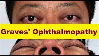 Graves Ophthalmopathy [upl. by Joellyn90]