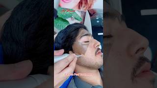 Carbon Peel Laser getsmarthairclub viralvideo beauty [upl. by O'Meara107]