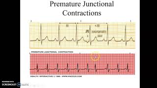 Junctional Rhythms and Premature Junctional Contractions [upl. by Ainsworth]