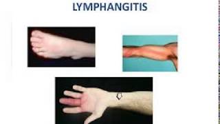 LYMPHANGITIS LEARN ABOUT PHLF [upl. by Dorkus]