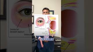 Tampa Under Eye Filler [upl. by Chev]