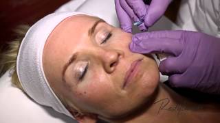 Dr Berne Harmony Program Oslo Azzalure Botox Restylane Tear Trough [upl. by Yllrebmik]