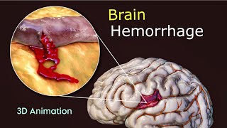 What Triggers Brain Hemorrhage  3D Animation  Scopic Vision [upl. by Lachlan]