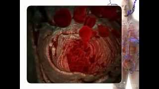 3D Medical Animation Congestive Heart Failure Module 3 [upl. by Notgnihsaw]