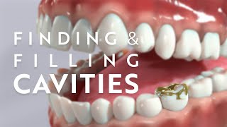 The process of finding and filling dental cavities [upl. by Aicak782]