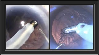 Learn the technique of Irrigation and Aspiration Part 2  the Unimanual or the Coaxial IA technique [upl. by Culhert]