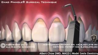 Pinhole Surgical Technique for Gum Recession in Fort Lauderdale FL [upl. by Abbottson550]