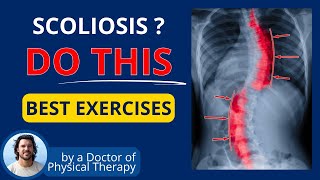 10 NEW Exercises for Scoliosis Relief [upl. by Klos518]