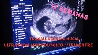 ULTRASSOM MORFOLÓGICO 1°TRIMESTRE 12 SEMANAS E 2 DIAS TRANSLUCÊNCIA NUCAL [upl. by Reppart]