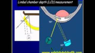 Gonioscopy Lecture part 08 YouTube [upl. by Kauffmann]