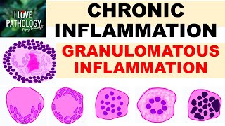 INFLAMMATION Part 9 Chronic Inflammation  GRANULOMATOUS INFLAMMATION [upl. by Irrab]