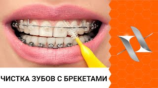 Полный алгоритм чистки зубов с брекетами 6 шагов [upl. by Gnad]