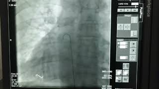 Right sided heart with heart attackDextrocardia with Acute inferior MIEcgampCinefluoroscopy findings [upl. by Arok]