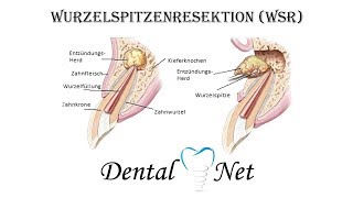 Wurzelspitzenresektion WSR ablauf [upl. by Johnny]