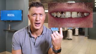 Dentist says DO NOT CROWN YOUR TEETH  Proves it with a Clinical example [upl. by Annette]