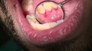 Dresam part 2 gingival index [upl. by Ahtelra70]