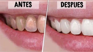 ¡DIENTES BLANCOS EN 2 MINUTOS REMEDIOS CASEROS Y NATURALES PARA BLANQUEAR LOS DIENTES  Vania [upl. by Dalila820]