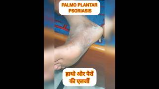 PALMOPLANTAR PSORIASIS psoriasis itching dryskin shortsfeed shortvideo shorts ytviral SHORT [upl. by Lleynad]