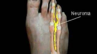 Excision of Mortons Neuroma  Surgical Animation [upl. by Daveda]