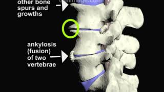 Degenerative Disc Disease of the Spine ALIF Part 1  Animation by Cal Shipley MD [upl. by Forrester]