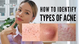 How to treat EVERY type of acne With Pictures [upl. by Barcroft]