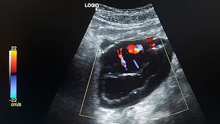 ultrasound case  Small bowel lymphoma [upl. by Kandy]