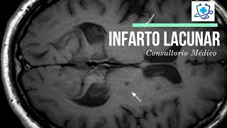 Infarto Lacunar Causas Síntomas y Tratamiento 👨‍⚕️ Consultorio Médico [upl. by Yarahs658]