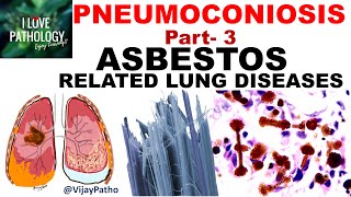 PNEUMOCONIOSIS Part 3 ASBESTOS related lung diseases [upl. by Evita512]