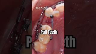 How to pull teeth when braces braces orthodontist dentist dental [upl. by Etnelav693]