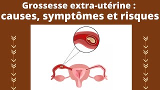 Grossesse extrautérine  causes symptômes et risques  santé [upl. by Rebm]