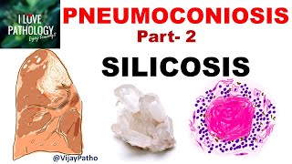 PNEUMOCONIOSIS Part 2 Silicosis pathogenesis morphology  clinical features amp complications [upl. by Adym]