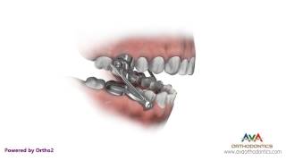 Orthodontics Treatment for Overjet Overbite  Herbst Appliance [upl. by Linea]