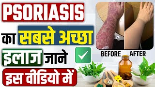 सोरायसिस का सबसे अच्छा इलाज क्या होता है  Treatment of psoriasis disease  Psoriasis ka ilaj [upl. by Dwan102]