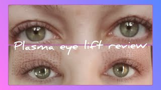 plasma fibroblast eye lift review  mid way through treatment [upl. by Minerva]