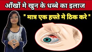 Sub Cunjuctiva Hemorrhage Treatment  Ankho Me khun ke Lal Dhabbe Ka Ilaz  In Hindi [upl. by Diskin]