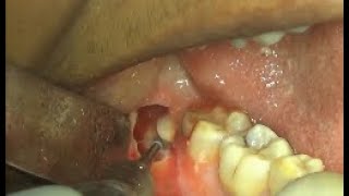 Upper impacted wisdom tooth extraction video [upl. by Iliam415]