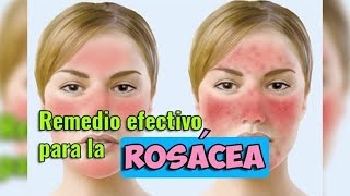 Remedio efectivo para rosácea un solo ingrediente  EcoDaisy [upl. by Acsehcnarf]