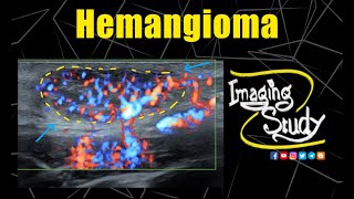 Superficial Hemangioma  Ultrasound  Doppler  Case 309 [upl. by Hyacinthia772]