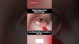 Subconjunctival Hemorrhage shorts pictures [upl. by Huntley]