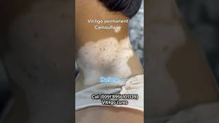 VITILIGO PERMANENT COSMETIC TATTOOING  VITILIGO TREATMENT  vitiligoindia whitespottreatment [upl. by Geirk]