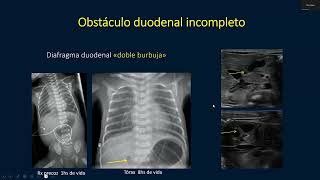 Reunión Científica Virtual 18052023  quotPatología intestinal fetal Aportes de la RMF [upl. by Asserac]