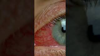 mySkinDoc talks about Ocular Rosacea [upl. by Llenal]