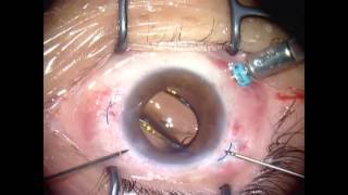 Sutureless intrascleral intraocular lens fixation – Supplementary Video ID 101515 [upl. by Ssirk760]