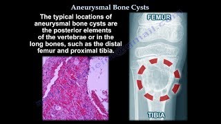 Aneurysmal Bone Cyst  Everything You Need To Know  Dr Nabil Ebraheim [upl. by Gilges]