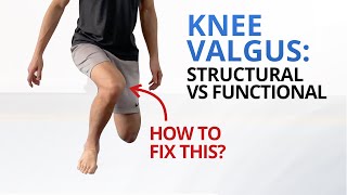 Why You Need to Fix Dynamic Knee Valgus NOW [upl. by Ateloiv]