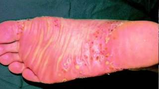 Types of Psoriasis  An Overview [upl. by Greggory]