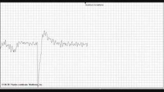 Tracciato Ecg Fibrillazione Ventricolare [upl. by Tanner]