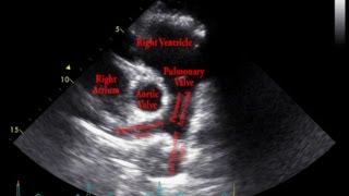 Echocardiogram Parasternal Short Axis View Pulmonary Arteries  Loop [upl. by Haneeja]