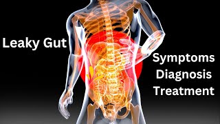 The Ultimate Guide to Leaky Gut Causes Symptoms and Treatment [upl. by Aphra]